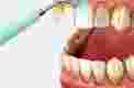 удаление отложений на зубах при помощи ультразвуковой чистки