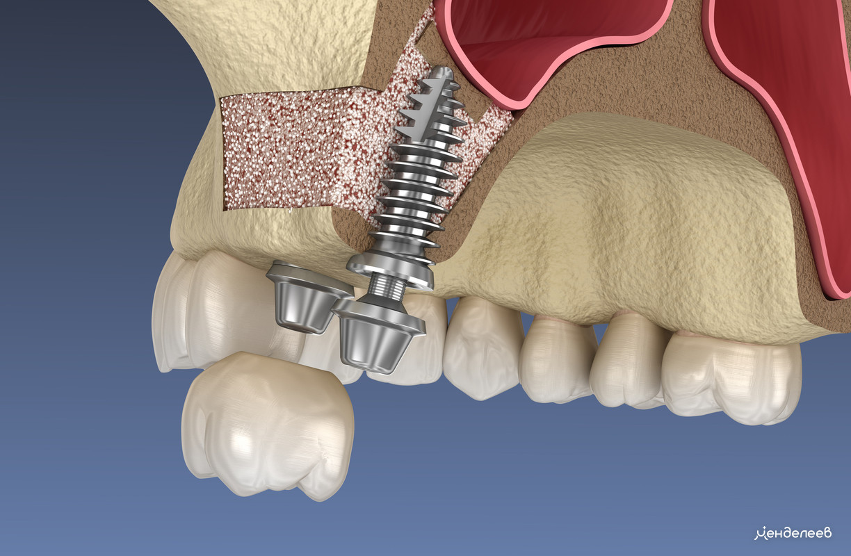 Перфорация гайморовой пазухи при удалении зуба: что нужно знать