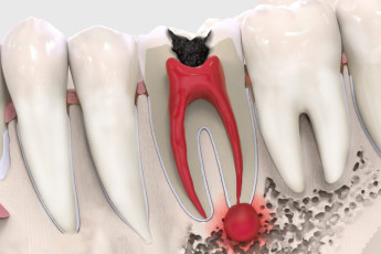 Лечение каналов зуба цена в Москве: записаться на лечение каналов зуба
