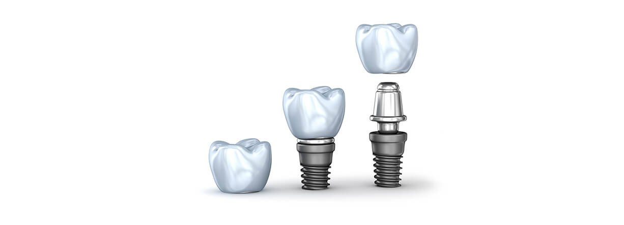 Как устанавливают зубные коронки на импланты