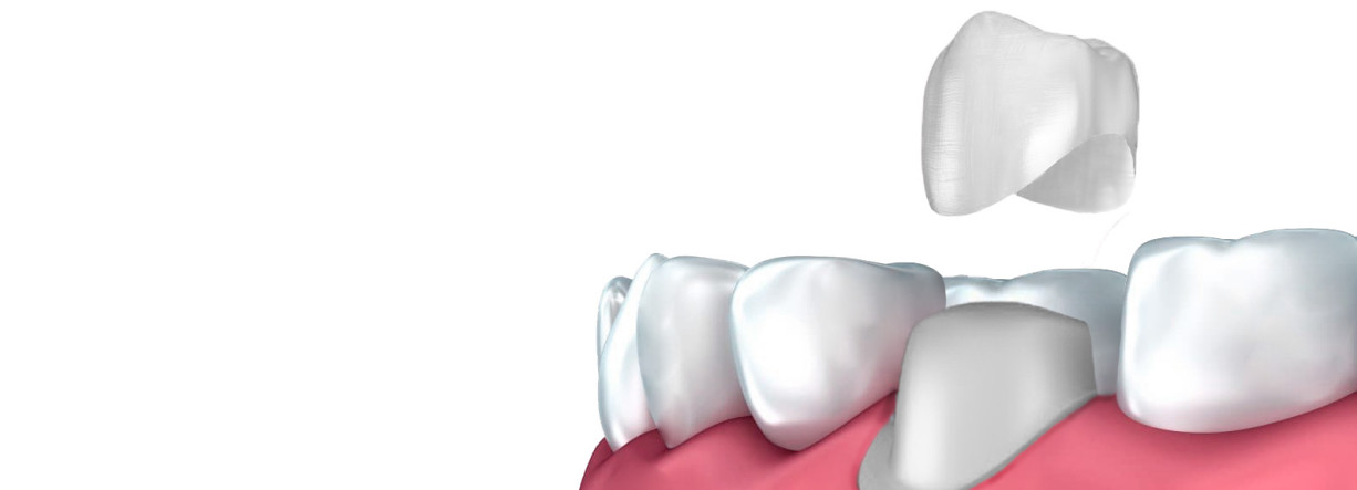 Эстетическое восстановление коронковой части зуба. Какие коронки на зубы лучше ставить. Какие коронки лучше ставить на жевательные. Как ставят коронки на зубы этапы. Неприятное ощущение на зубах