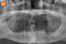 Компьютерная томография челюсти с полной адентией